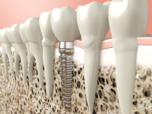 nadomestitev zoba ustna medicina